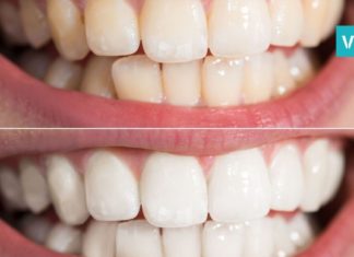 ნადები კბილებიდან 5 წუთში გაქრება-ეფექტური მეთოდი თქვენთვის!