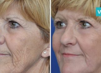 სახამებელი ბოტოქსის წინააღმდეგ: საუკეთესო ნიღაბი სახის კანისთვის!