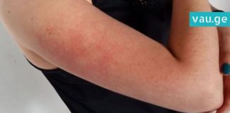 აი, რა უნდა იცოდეთ მკლავებზე არსებული გამონაყარის,იგივე, “ქათმის კანის” შესახებ-მოიშორეთ ისინი მარტივად!