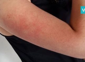 აი, რა უნდა იცოდეთ მკლავებზე არსებული გამონაყარის,იგივე, “ქათმის კანის” შესახებ-მოიშორეთ ისინი მარტივად!