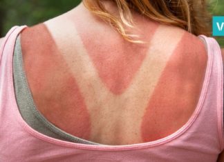 მზისგან დამწვრობის ლოსიონი, რომელიც დაგიმშვიდებთ კანს! 2 ინგრედიენტია მარტო საჭირო!