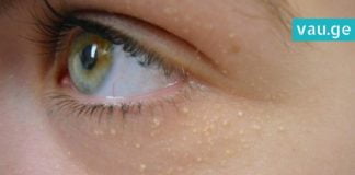 ამ ბუნებრივი საშუალებებით შეძლებთ თეთრი წინწკლების მოშორებას! გაიგეთ მეტი…