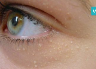 ამ ბუნებრივი საშუალებებით შეძლებთ თეთრი წინწკლების მოშორებას! გაიგეთ მეტი…