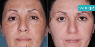 როგორ გავთავისუფლდეთ სწრაფად პიგმენტური ლაქებისგან? ორინგრედიენტიანი რეცეპტი!