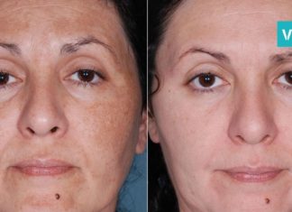 როგორ გავთავისუფლდეთ სწრაფად პიგმენტური ლაქებისგან? ორინგრედიენტიანი რეცეპტი!