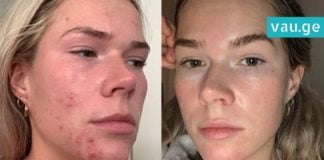 თუ სახეს ქოქოსის ზეთით და სოდით გაისუფთავებთ 3 კვირაში თქვენს სახეს ეს დაემართება