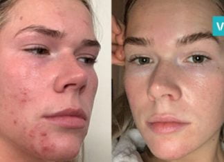 თუ სახეს ქოქოსის ზეთით და სოდით გაისუფთავებთ 3 კვირაში თქვენს სახეს ეს დაემართება