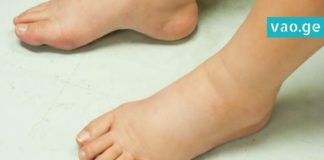 ფეხები გიშუპდებათ? ეს რეცეპტები სამუდამოდ დაგავიწყებთ ამ პრობლემას