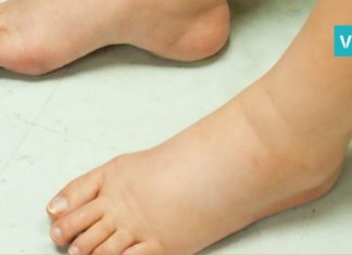 ფეხები გიშუპდებათ? ეს რეცეპტები სამუდამოდ დაგავიწყებთ ამ პრობლემას