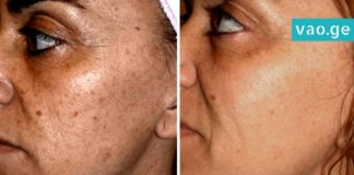 მხოლოდ ერთი წვეთი იოდი პიგმენტური ლაქების მოსაშორებლად! შედეგით გაოცებული დარჩებით