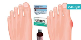 ანალგინი, ასპირინი და იოდი პოდაგრის სამკურნალოდ. სასწაულმოქმედი ნარევია!