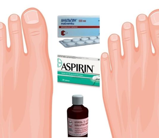 ანალგინი, ასპირინი და იოდი პოდაგრის სამკურნალოდ. სასწაულმოქმედი ნარევია!