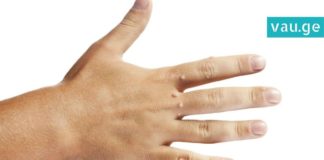 როგორ მოვიშოროთ მეჭეჭი? ოთხი ყველაზე სწრაფი და ეფექტური მეთოდი