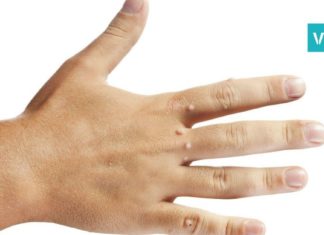 როგორ მოვიშოროთ მეჭეჭი? ოთხი ყველაზე სწრაფი და ეფექტური მეთოდი