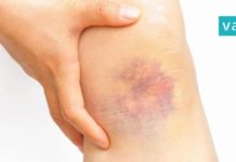 კანზე სილურჯეების გაჩენის მიზეზები. ის, რის შესახებაც ბევრმა არ იცის