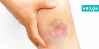 კანზე სილურჯეების გაჩენის მიზეზები. ის, რის შესახებაც ბევრმა არ იცის