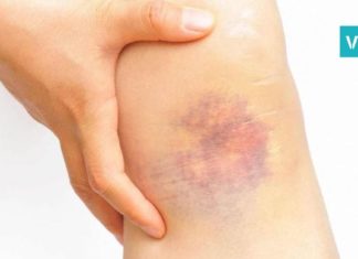 კანზე სილურჯეების გაჩენის მიზეზები. ის, რის შესახებაც ბევრმა არ იცის