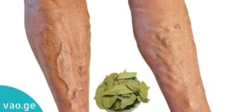 დაფნის ფოთლებით ვენების ვარიკოზისა და სახსრების ტკივილისგან განიკურნებით