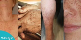 პიგმენტური ლაქების მოშორების სუპერმეთოდი სახლის პირობებში. შედეგი გარანტირებულია!