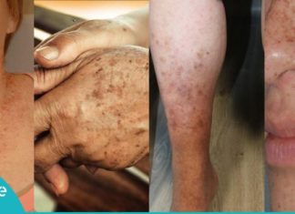 პიგმენტური ლაქების მოშორების სუპერმეთოდი სახლის პირობებში. შედეგი გარანტირებულია!