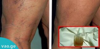 მოშორეთ კაპილარების პრობლემა, დაუბრუნეთ კანს სილამაზე საოცარი ბალზამით-ეფექტურია!