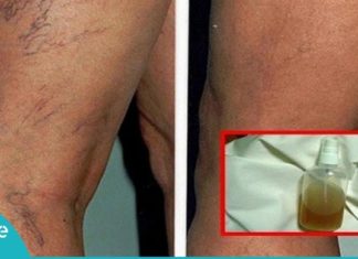 მოშორეთ კაპილარების პრობლემა, დაუბრუნეთ კანს სილამაზე საოცარი ბალზამით-ეფექტურია!