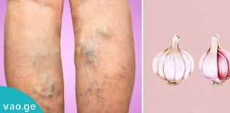 ვარიკოზული ვენების მოშორების იაფი და მარტივი გზა. მხოლოდ რამდენიმე ინგრედიენტი დაგჭირდებათ