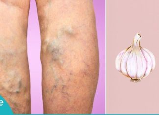 ვარიკოზული ვენების მოშორების იაფი და მარტივი გზა. მხოლოდ რამდენიმე ინგრედიენტი დაგჭირდებათ