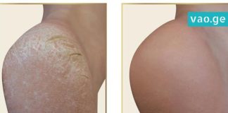 გამოიყენეთ ეს საშუალება და სამუდამოდ დაემშვიდობეთ დახეთქილ ქუსლებს