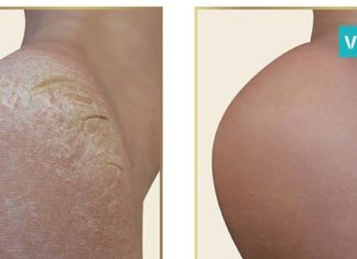 გამოიყენეთ ეს საშუალება და სამუდამოდ დაემშვიდობეთ დახეთქილ ქუსლებს