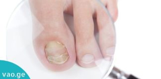 ფრჩხილის სოკოს მკურნალობის 5 ეფექტური მეთოდი. ეს დაავადება აღარ შეგაწუხებთ.