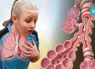 ასთმის და ბრონქიტის მკურნალობის საუკეთესო გზა. ეს რეცეფტი პრობლემას სამუდამოდ დაგავიწყებთ