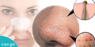 შავი წერტილების მოშორების ყველაზე ეფექტური მეთოდები. ეს ნიღბები შავ წერტილებს სამუდამოდ გაგიქრობენ