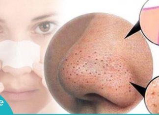 შავი წერტილების მოშორების ყველაზე ეფექტური მეთოდები. ეს ნიღბები შავ წერტილებს სამუდამოდ გაგიქრობენ