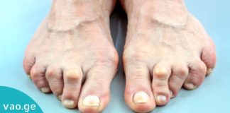 საუკეთესო საშუალება რევმატოიდული ართრიტის დროს- ტკივილი უკვალოდ გაქრება! გაიგეთ მეტი…