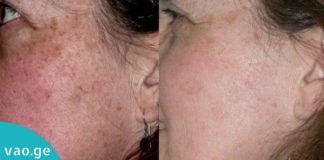 მოიშორეთ სახიდან ლაქები ყველაზე მარტივად! ეფექტური მეთოდი თქვენთვის!