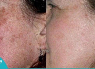 მოიშორეთ სახიდან ლაქები ყველაზე მარტივად! ეფექტური მეთოდი თქვენთვის!