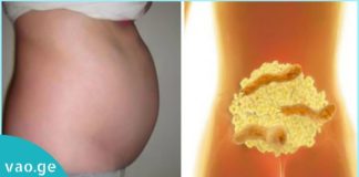 აი ეს ბაქტერია იწვევს მუცლის შებერილობას! გათავისუფლდით მისგან ამ ნაყენის საშუალებით!