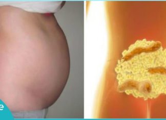 აი ეს ბაქტერია იწვევს მუცლის შებერილობას! გათავისუფლდით მისგან ამ ნაყენის საშუალებით!