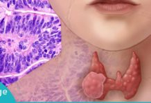 ფაფა ფარისებრი ჯირკვლისთვის! გაიმარჯვეთ პრობლემაზე მარტივად და იაფად!