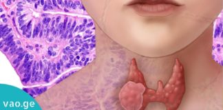 ფაფა ფარისებრი ჯირკვლისთვის! გაიმარჯვეთ პრობლემაზე მარტივად და იაფად!