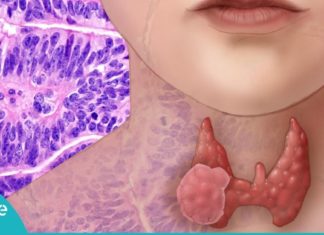 ფაფა ფარისებრი ჯირკვლისთვის! გაიმარჯვეთ პრობლემაზე მარტივად და იაფად!