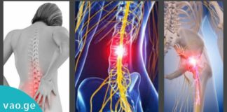 რადიკულიტის მკურნალობის 8 ეფექტური მეთოდი – საცდეთ გამაყუჩებლების ნაცვლად!