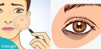 აი, როგორ უნდა მოიშოროთ ჩაშავებული უპეები და აკნე მხოლოდ ერთი ინგრედიენტით…