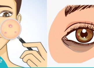 აი, როგორ უნდა მოიშოროთ ჩაშავებული უპეები და აკნე მხოლოდ ერთი ინგრედიენტით…