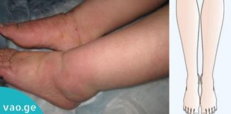 7 წესი, თუ რა უნდა ქნათ ფეხების შეშუპების დროს! ეს აუცილებლად დაგეხმარებათ!