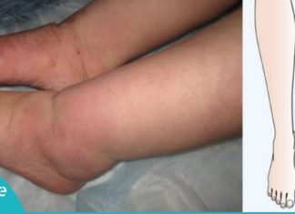 7 წესი, თუ რა უნდა ქნათ ფეხების შეშუპების დროს! ეს აუცილებლად დაგეხმარებათ!