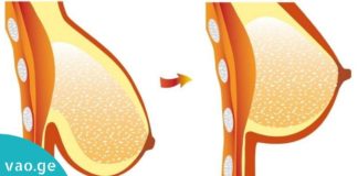 აირიდეთ თავიდან მოშვებული მკერდის პრობლემა – სასარგებლო რჩევები!