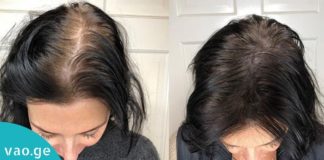 როგორ ავიცილოთ თავიდან თმის ცვენა! მარტივი და იაფი საშუალება…