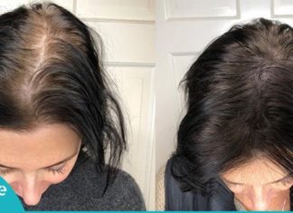 როგორ ავიცილოთ თავიდან თმის ცვენა! მარტივი და იაფი საშუალება…